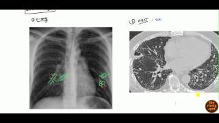 Bronchiectasis for USMLE [upl. by Lenoel]