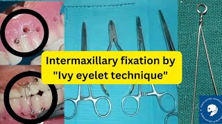 INTERMAXILLARY FIXATION IMF [upl. by Sanders]