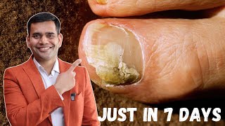 Just in 7 Days Cure Toenail Fungus At Home  Best Remedy For Toenail Fungus  Dr Vivek Joshi [upl. by Notneb51]