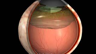 Krankheiten des Auges Hintere Glaskörperabhebung [upl. by Retxed134]