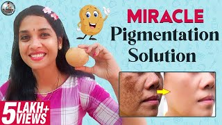 Miracle Pigmentation Solution  DIY Potato Facial Mask  Lakshya Junction [upl. by Layney]