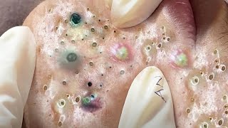 Big Cystic Acne Blackheads Extraction Blackheads amp Milia Whiteheads Removal Pimple Popping  395 [upl. by Suhpesoj650]