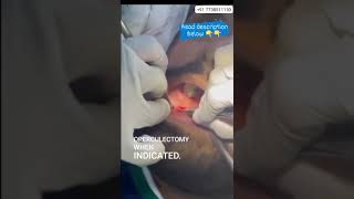 Operculectomy procedure [upl. by Etessil]