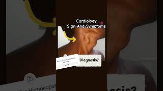 Corigan Sign Dancing Carotid cardiology physiology  FERRUM MET NAJA TRI SPIGELIA ANT [upl. by Gaudette420]