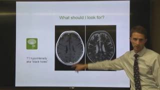 OhioHealth Multiple Sclerosis LectureUnderstanding Your MRI [upl. by Dibbrun467]