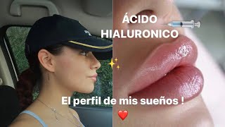 Armonización facial SIN CIRUGÍA💉👀🩷🤭 Anel Flynn [upl. by Tiga]