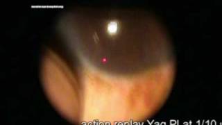 laser iridotomy for angle closure glaucoma [upl. by Ecylahs]