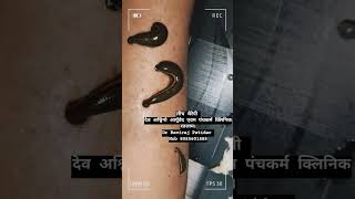 Leech therapy for swelling  Dr Raviraj Patidar  Dev Ashvino Ayurved Panchkarma clinic Ratlam। [upl. by Truda]