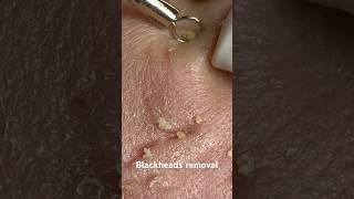 Blackheads removal blackheads acnetreatment poping lylybeautyspa shorts [upl. by Syverson]