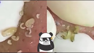 Ultimate Satisfying Pimple Popping Compilation 2024  Best Blackhead amp Acne Removal Video [upl. by Eillom]