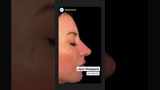 Liquid Rhinoplasty Before and After Dallas Nurse Injector dallasplasticsurgery nosejob fillers [upl. by Sneed]