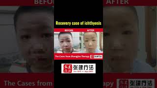 Real recovery case of ichthyosis of head and face parts ichthyosis skincare dermatologistdryskin [upl. by Ettelorahc]