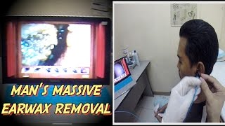 Mans Massive Earwax Removal [upl. by Noed938]