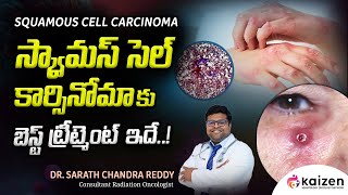 BEST treatment for squamous cell carcinoma  DrSarath Chandra Reddy  Kaizen Hematology Network [upl. by Anivel]