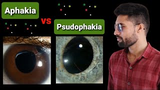 Aphakia  Psudophakia lecture opthalmology [upl. by Aryamo]