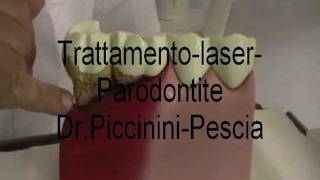 Trattamento parodontite laser [upl. by Inaboy]