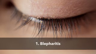 1 Blepharitis [upl. by Caesar984]