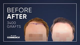 COSMEDICA DRACAR 3400 Grafts FUE Hair Transplant in TurkeyIstanbul [upl. by Gosney614]