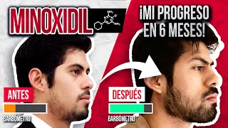 6 MESES USANDO MINOXIDIL PARA CRECER MI BARBA  ¿SIRVE EXPLICACIÓN CON CIENCIA [upl. by Juliet]