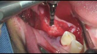 Dentium dental implant Prosthetic 4546478wmv [upl. by Lockwood]