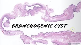 Bronchogenic Cyst 5Minute Pathology Pearls [upl. by Revert]