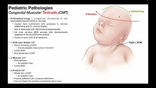 Torticollis → Mechanism Pathophysiology amp Effects in Infants [upl. by Einot230]