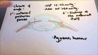 Acute angle closure glaucoma [upl. by Vernier]