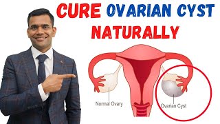 Just 3 Recommendations To Cure Ovarian Cyst Naturally  Dr Vivek Joshi [upl. by Jephum]