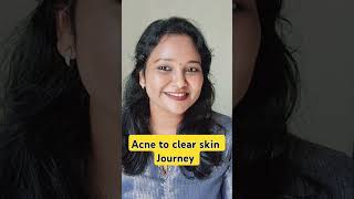 Acne to clear skin Journey 🔥acne acneproneskin skincare skincareroutine clearskin [upl. by Enenaej853]