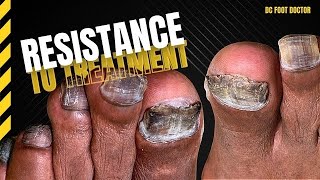 Resistance To Treatment Fungal Toenails [upl. by Revolc]