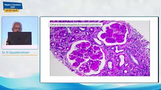 Paraproteinemia  MGRS  Dr N Gopalakrishnan [upl. by Nawak827]