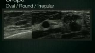 Breast Ultrasound Lesion Assessment BIRADS Ultrasound [upl. by Aremihc]