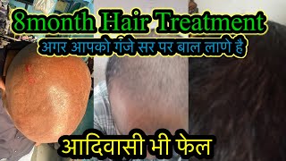 100 hair growth process नये बाल उगाने का treatment  hairgrowth minoxidil [upl. by Dahsar569]