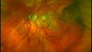 Determination of Quantitative Macular Perfusion Assessment in Surgical and Non surgical Cases [upl. by Acyssej]