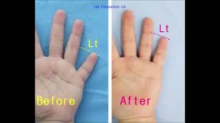 brachydactyly brachydactylytypeD 短指症手術 短指症 マムシ指 しゃもじ指 まむし指 단지증 단지증수술 단지증수술후기 [upl. by Eilyak]