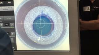 Corneal Tissue Addition Keratoplasty CTAK  CAIRS for Keratoconus [upl. by Irrahs]