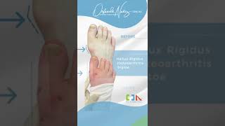 Hallux Rigidus Osteoarthritis bigtoe joint [upl. by Sells183]