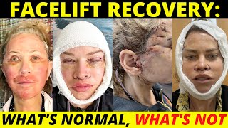 Facelift recovery day by day Whats normal whats not [upl. by Idnak]