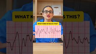 How To Read A ECG ventricular fibrillation shorts [upl. by Haneen478]