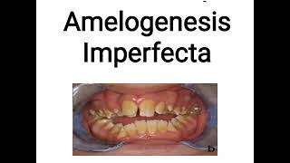 Amelogenesis Imperfecta [upl. by Enenaj]