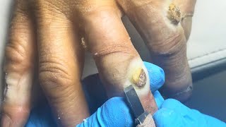 Wow Six huge plantar warts on my hands pedicure pédicure [upl. by Ennaylime]