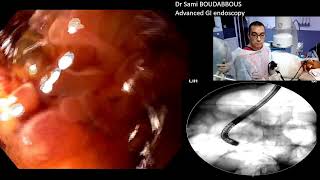 ERCP for severe acute cholangitis [upl. by Nitsyrk568]