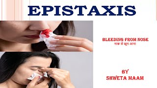 Episaxis causes signs and symptoms diagnosis and treatment BY SHWETA MAAM [upl. by Bette613]