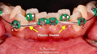 plastic sleeve in orthodontics  episode no 4 Quick orthodontic tips series Dr Amr Asker [upl. by Asiulairam]