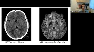 Pediatric Mild Traumatic Brain Injury  UCSF Neurosurgery Community Grand Rounds [upl. by Akcira]