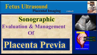 Fetus Ultrasound Placenta Previa [upl. by Janenna114]