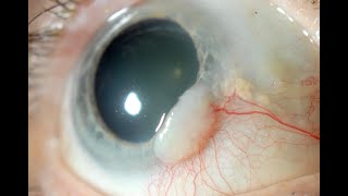 Biopsy of conjunctiva CPT code  simplify medical coding [upl. by Hesler]