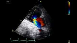 Pulmonary Embolism  Mcconnells Sign  Transthoracic Echocardiogram TTE [upl. by Julian]