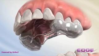 Rapid Palatal Expander RPE [upl. by Nomaj509]