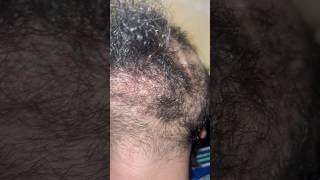 Beard hair removal removingingrown hairissue satisfying ingrownhairremoval hair ingrown [upl. by Natascha426]